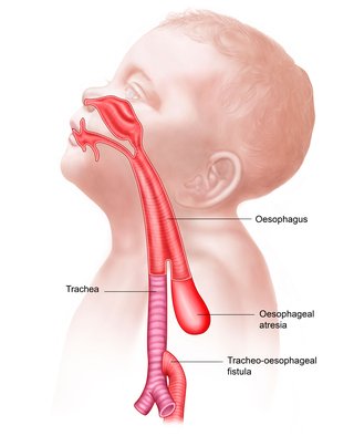 Annotated diagram of the head and shoulders of a young boy showing  oesophageal atresia and a tracheo-oesophageal fistula.
