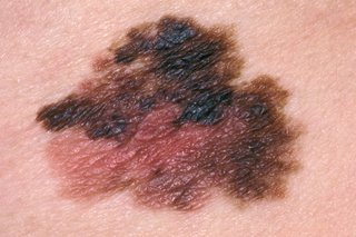 Picture of superficial spreading melanoma.