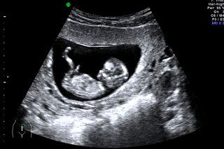 12-week black and white dating scan image of a baby in the womb