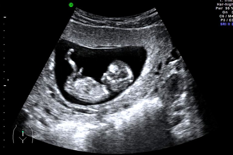 12week scan NHS