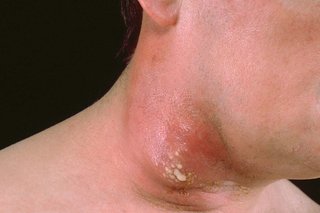 A group of boils growing together (carbuncle) on the neck on white skin. It's leaking yellow pus and the surrounding skin is red.