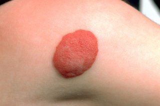 A large, red, raised mark with a bumpy texture, on pale skin.