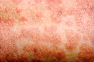 A close-up of the measles rash on someone with white skin, showing some raised red spots joined together to form blotchy patches.