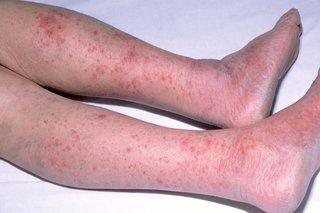 Red, spotty meningitis rash on a child's legs and feet. Shown on white skin.