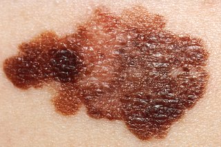 Picture of a melanoma