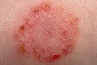 Circular patch of dry, red skin with a darker crust forming around the edge, caused by ringworm. Shown on white skin.