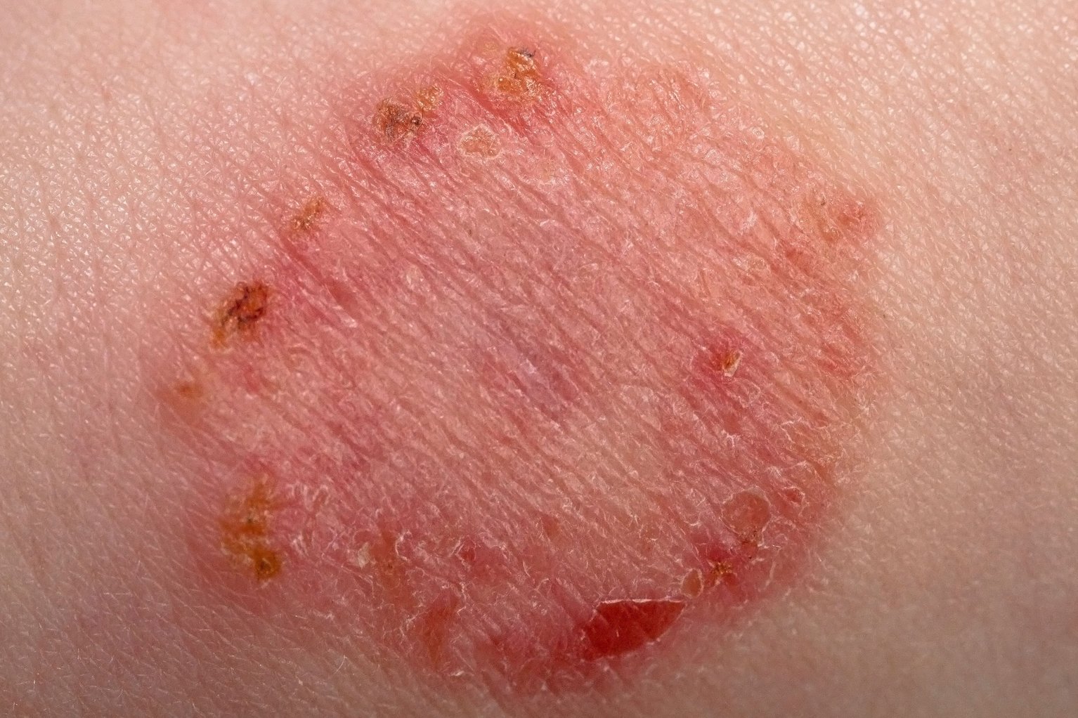 Rashes In Babies And Children NHS