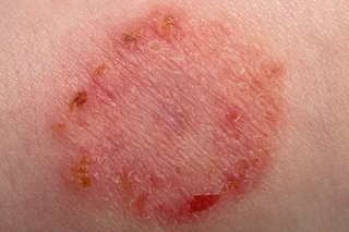 Circular patch of dry, red skin with a darker crust forming around the edge, caused by ringworm. Shown on white skin.