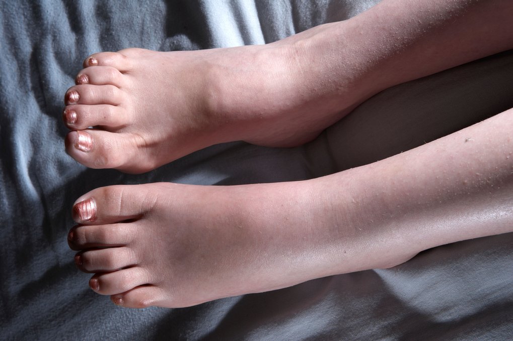 Swollen ankles, feet and legs (oedema) NHS
