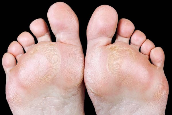 Callus removal from feet: balls of feet 