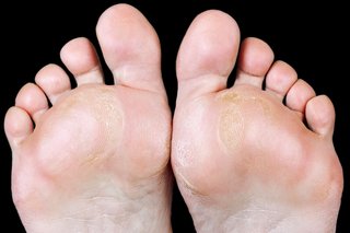 Calluses on the feet of a person with white skin. There are rough, yellow patches of skin on the balls of both feet.