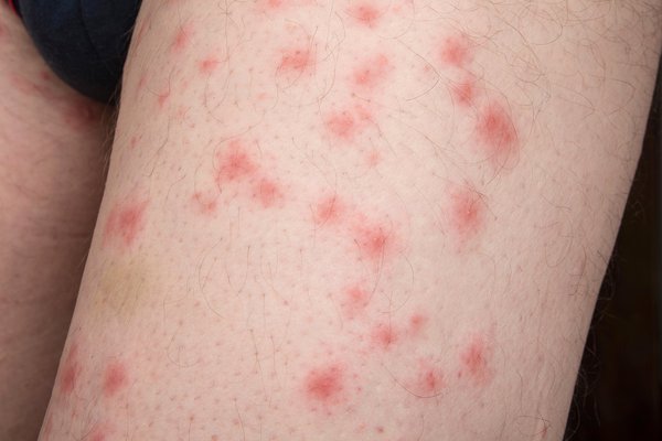 allergic reaction to bed bug bites