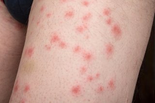 Bedbug bites on the thigh of someone with white skin. There are over 20 small red spots on the skin where bedbugs have bitten the skin.