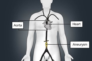 Picture of the human body showing an abdominal aortic aneurysm in the tummy. The aorta runs from the heart down to the tummy before separating into 2 branches and running down the legs.