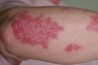 Patches of psoriasis on someone's arm. The image shows a raised, red rash with silvery-white scales on white skin.