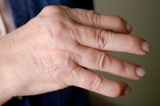 Close-up of a person's hand showing arthritis in the knuckles and finger joints. Shown on white skin.