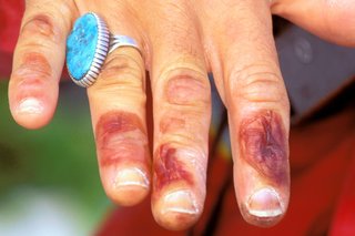 Close-up of a person's fingers with dark red blistering on their index, middle and ring fingers.