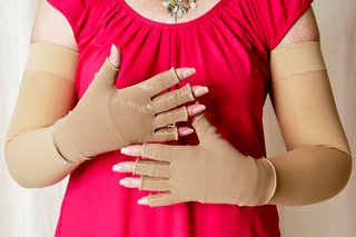 Woman wearing compression bandages on both her arms and hands.