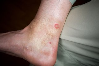 A horsefly bite on the lower leg of someone with white skin. There is a large round, red area where the skin was bitten.