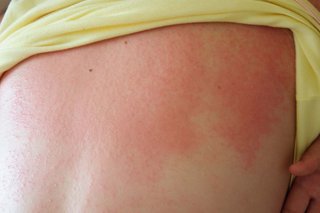 Patches of red skin across the upper back, caused by heat rash. Shown on white skin.