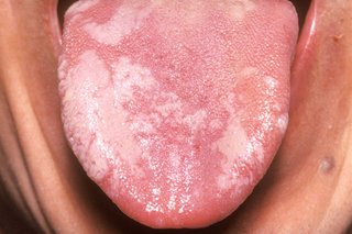 Pink tongue with white patches on the left side, poking out of a person's mouth.