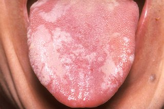 Mean biting of inside mouth what the does your Cheek biting: