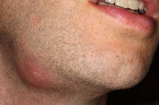 Picture of an abscess on a person's chin
