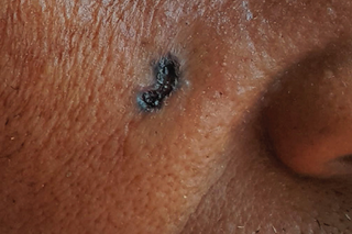 A black patch on a person's right cheek, underneath their eye. Shown on dark brown skin.