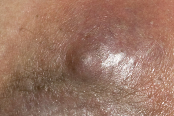 Large Pimple On Inner Thigh, You can get a cortisone shot to make them less  inflamed.