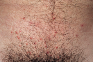 A close-up of the pubic area with small red spots (shown on white skin).