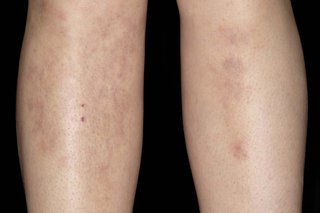 A person's shins with patches of skin that look like bruises. They have white skin and the area of discoloured skin is larger on their right shin.