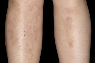 A person's shins with patches of skin that look like bruises. They have white skin and the area of discoloured skin is larger on their right shin.