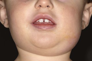 Lower half of a child’s face with a swollen cheek and neck on right side from mumps. Shown on white skin.