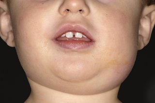 Lower half of child's face with a swollen cheek and neck on right side from mumps. Shown on white skin.