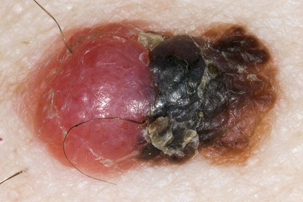 cancerous moles early signs