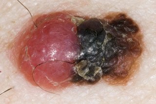Close-up of a melanoma on white skin. The melanoma is red and swollen, with crusty brown and black areas.