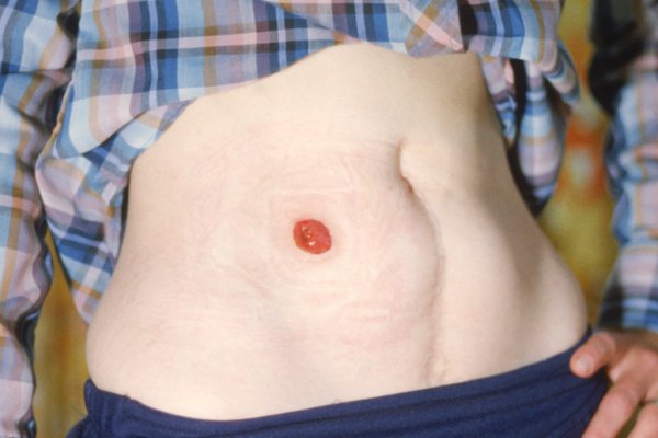 Stoma in tummy