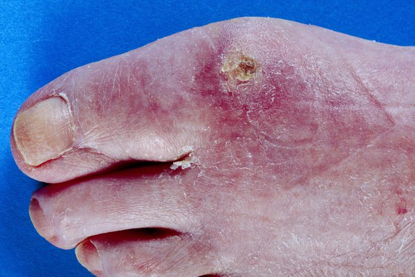 Scleroderma on white skin. A red rash and a small patch of yellow, crusty skin around the toes.