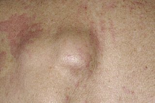 A pea-sized lipoma under white skin.