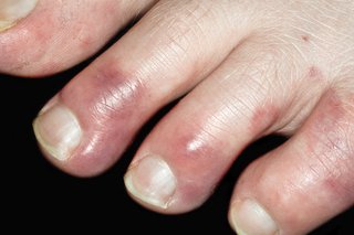 Close-up of chilblains on the toes of a person with white skin. The tips of the toes are swollen and red.