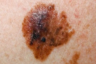 A melanoma which is brown with a black area and uneven borders on white skin