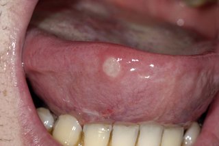 A white, round ulcer on the underside of someone's tongue, which is poking out of their mouth.