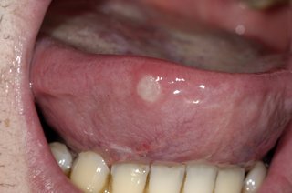 A large, white, circular mouth ulcer on the underside of the tongue.