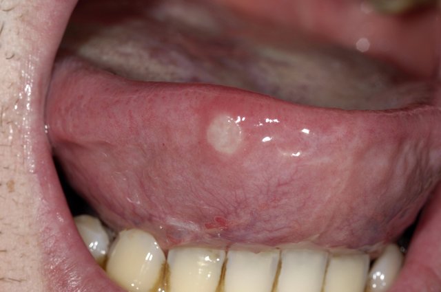 What does a canker sore look like on a tongue Mouth Ulcers Nhs