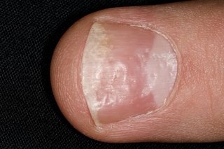 A close-up of a fingernail in a person with psoriasis. The nail has several small pits and dents in it.