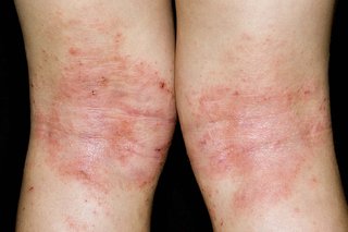 Patches of red, scaly skin on the back of the knees, caused by eczema. Shown on white skin.