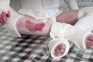 A pink wound on a child's shin. Skin is peeling on their fingers and toes. Bandages cover their feet, knees, arms and torso. Shown on white skin.
