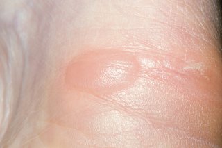 An oval-shape bump on the skin that's filled with clear fluid. The skin over the blister is pink and shiny.