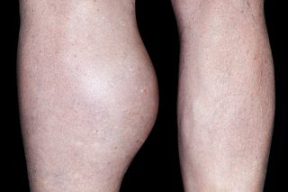 Lower legs of a person with white skin, on black background. The leg on the left has large lump at the back, below the knee.