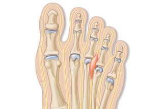 Illustration showing the bones in the top of the foot or toe area. There is a red area between the joints of the 3rd and 4th toes, showing the nerve Morton’s neuroma usually affects.